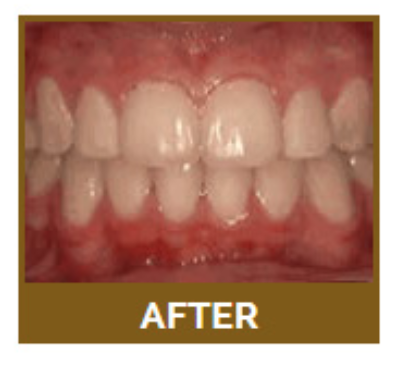 Crowding of the teeth - What is it? Crowded teeth occur either when a person’s jaw is relatively small or their teeth are relatively large, meaning there is not enough space for the teeth to form in neat rows. Typically, some teeth will be crooked, overlap others, or be out of place.

How is it treated? Nearly all cases of crowded teeth can be treated with braces. If the patient is already an adult, a combination of braces and expanders might be used. In any case, braces will be used for approximately 2 years.