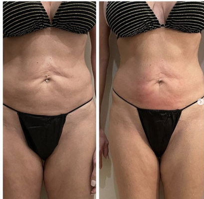 Body Contouring + Skin Tightening - Results…Results…Results. Real Results After 2 skin tightening treatments. Body Contouring + Skin Tightening - Results…Results…Results. Real Results After 2 skin tightening treatments.