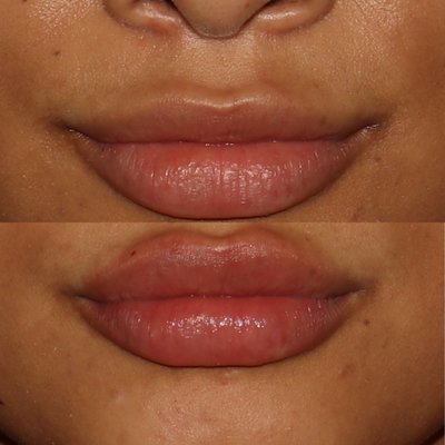 Lip Fillers - Lip fillers can look natural and beautiful. Lip Fillers - Lip fillers can look natural and beautiful.