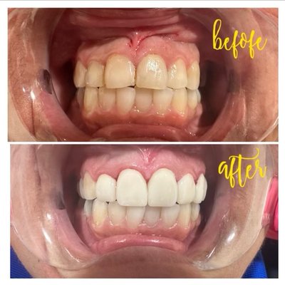 Ceramic dental crowns! - Dental crowns to restore and improve appearance of natural dentition Ceramic dental crowns! - Dental crowns to restore and improve appearance of natural dentition
