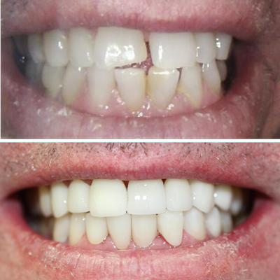 Veneers Before and After - Call us to schedule a consultation! (562) 568-7467 https://dentistlongbeach.com/ Veneers Before and After - Call us to schedule a consultation! (562) 568-7467 https://dentistlongbeach.com/