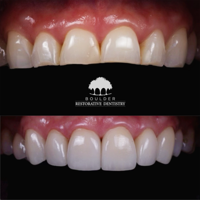 Crowns - Before and after crowns