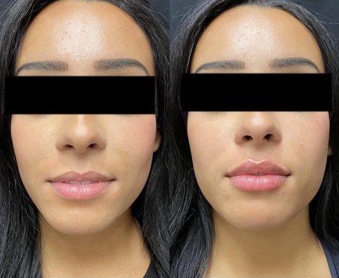 Lip Filler - Lip fillers are injections that add volume to your lips. They're a type of dermal filler. Lip fillers consist of synthetic hyaluronic acid (HA)