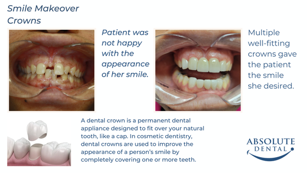 Crowns for Smile Makeover - Patient was not happy with the appearance of her smile.
Multiple well-fitting crowns gave the patient the smile she desired. Crowns for Smile Makeover - Patient was not happy with the appearance of her smile.
Multiple well-fitting crowns gave the patient the smile she desired.