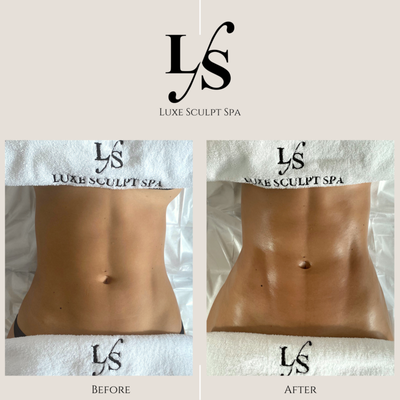 Ultimate Luxe Sculpt Drainage Treatment - Ultimate Luxe Sculpt Drainage | 75 Minutes

Your body works hard every day—and sometimes it needs help releasing what it no longer needs.

Our signature Ultimate Luxe Sculpt Drainage is a 75-minute full-body and facial sculpting experience designed to help reduce bloating, encourage lymphatic flow, contour the body, and leave you feeling lighter, tighter, and refreshed from head to toe.

This comprehensive treatment combines advanced technology, specialized sculpting tools, and expert manual lymphatic drainage techniques to stimulate circulation, support the body's natural detoxification process, and help move excess fluid that can contribute to puffiness, swelling, and stubborn areas of congestion.

Unlike traditional massages, this treatment is focused on creating visible results while promoting total-body wellness. We treat the entire body—including the face—to help define your natural contours, reduce facial puffiness, improve skin appearance, and enhance your overall sense of well-being.

Many clients leave feeling noticeably lighter, less bloated, more sculpted, and deeply relaxed after just one session.

Whether you're preparing for a special event, recovering from travel, looking to support your wellness goals, or simply wanting to look and feel your absolute best, the Ultimate Luxe Sculpt Drainage is the perfect reset for your body.

Feel lighter. Look sculpted. Experience the Luxe difference.