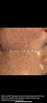 MicroBlading services and tattoos removal service mole removing. Pico way facial to beautify your skin. ￼ - We also specializing on skin problems. Tattoos removal, mole removal and get rid of wrinkles get rid of uneven skin￼. Get rid of pimple prom skin. MST water injection.