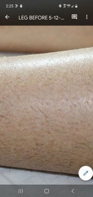 BEFORE/AFTER Legs Sugaring Hair Removal - Aong with the hair being removed via sugaring, notice the added benefit of exfoliation!! This client was using gallons of lotion but still dry itchy skin because you can't moisturize over built up dead skin! Now she is smooth AND can moisturize. BEFORE/AFTER Legs Sugaring Hair Removal - Aong with the hair being removed via sugaring, notice the added benefit of exfoliation!! This client was using gallons of lotion but still dry itchy skin because you can't moisturize over built up dead skin! Now she is smooth AND can moisturize.