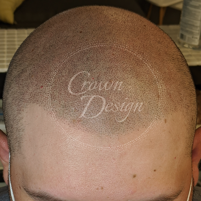 Redefined Hairline - Men's scalp pigmentation density fill, redefined hairline. Redefined Hairline - Men's scalp pigmentation density fill, redefined hairline.
