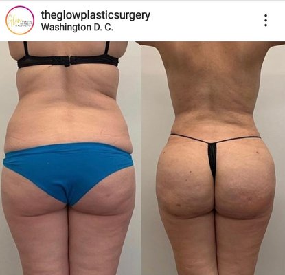 Brazilian Butt Lift: Before and After - The Brazilian butt lift, also known as a BBL or buttocks/gluteal augmentation, is meant to define and reposition the outer thighs and buttocks, so they appear more rounded and shapelier Brazilian Butt Lift: Before and After - The Brazilian butt lift, also known as a BBL or buttocks/gluteal augmentation, is meant to define and reposition the outer thighs and buttocks, so they appear more rounded and shapelier