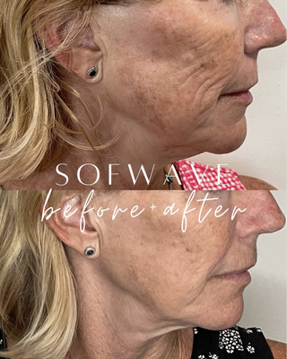 Sofwave Skin Tightening - Sofwave is the most effective, non-invasive treatment for lifting and tightening the skin. It uses a revolutionary SUPERB (synchronous ultrasound parallel beam) technology that penetrates the mid-dermis stimulating the remodeling of collagen, elastin, and hyaluronic acid in the skin. Sofwave will leave your skin looking refreshed lifted and radiant with minimal downtime. Schedule your consultation to learn more about the transformative benefits of Sofwave! Sofwave Skin Tightening - Sofwave is the most effective, non-invasive treatment for lifting and tightening the skin. It uses a revolutionary SUPERB (synchronous ultrasound parallel beam) technology that penetrates the mid-dermis stimulating the remodeling of collagen, elastin, and hyaluronic acid in the skin. Sofwave will leave your skin looking refreshed lifted and radiant with minimal downtime. Schedule your consultation to learn more about the transformative benefits of Sofwave!