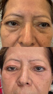 Fibroblast Skin Tightening & Lifting Treatment - Ionized technology uses plasma energy to restore and resurface the skins barrier. Helping excessive amounts of collagen cells to multiply. This creates new rejuvenated skin. The collagen production gives the skin a
smoother, firmer, and more youthful appearance, often described as "new" on “rejuvenated" skin. It typically takes a week. LASTING 3-5 YEARS Fibroblast Skin Tightening & Lifting Treatment - Ionized technology uses plasma energy to restore and resurface the skins barrier. Helping excessive amounts of collagen cells to multiply. This creates new rejuvenated skin. The collagen production gives the skin a
smoother, firmer, and more youthful appearance, often described as "new" on “rejuvenated" skin. It typically takes a week. LASTING 3-5 YEARS