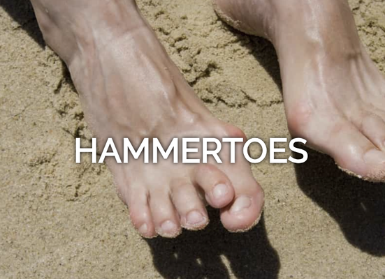 Hammertoes - Hammertoe is a deformity where one or both joints of the second, third, fourth or fifth toes begin to bend outside of their normal alignment. Pressure can begin to weigh heavy on the toes as you wear shoes which is where pain and other symptoms develop.
Hammertoes typically begin with small symptoms and deformities and continue to worsen with time. In its beginning stages, hammertoes are often impressionable which means they can be controlled using minimal treatment. It is important to know the signs of hammertoes to get them evaluated early. If left untreated, hammertoes can become more firm and difficult to manipulate, requiring surgery.
Common symptoms of hammertoes include:
Pain or irritation of the affected toe when wearing shoes.
Corns and calluses (a buildup of skin) on the toe, between two toes or on the ball of the foot. Corns are caused by constant friction against the shoe. They may be soft or hard, depending on their location.
Inflammation, redness or a burning sensation
Bending of the toe
In more severe cases of hammertoe, open sores may form.
If you have any questions about our services, please contact us today! Hammertoes - Hammertoe is a deformity where one or both joints of the second, third, fourth or fifth toes begin to bend outside of their normal alignment. Pressure can begin to weigh heavy on the toes as you wear shoes which is where pain and other symptoms develop.
Hammertoes typically begin with small symptoms and deformities and continue to worsen with time. In its beginning stages, hammertoes are often impressionable which means they can be controlled using minimal treatment. It is important to know the signs of hammertoes to get them evaluated early. If left untreated, hammertoes can become more firm and difficult to manipulate, requiring surgery.
Common symptoms of hammertoes include:
Pain or irritation of the affected toe when wearing shoes.
Corns and calluses (a buildup of skin) on the toe, between two toes or on the ball of the foot. Corns are caused by constant friction against the shoe. They may be soft or hard, depending on their location.
Inflammation, redness or a burning sensation
Bending of the toe
In more severe cases of hammertoe, open sores may form.
If you have any questions about our services, please contact us today!
