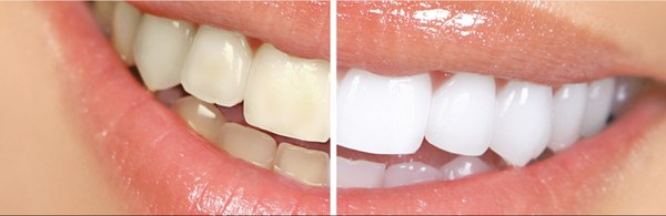 Teeth Whitening - Teeth Whitening