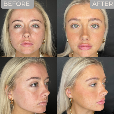 Full Face Rejuvenations with Dermal Fillers - Are you ready to turn back the clock and restore a youthful, radiant look to your face? Our collection of Restylane and Juvederm fillers can help! Whether you want to plump up your lips, enhance your cheekbones, or smooth out wrinkles and lines, our cosmetic injectables can give you the natural, beautiful results you desire. Full Face Rejuvenations with Dermal Fillers - Are you ready to turn back the clock and restore a youthful, radiant look to your face? Our collection of Restylane and Juvederm fillers can help! Whether you want to plump up your lips, enhance your cheekbones, or smooth out wrinkles and lines, our cosmetic injectables can give you the natural, beautiful results you desire.