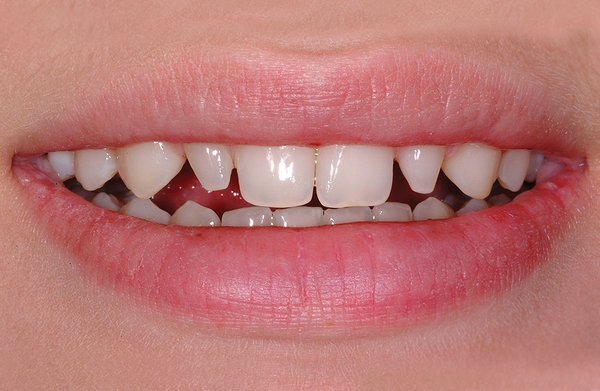 Fixing “peg laterals” with Bioclear - It’s common to be born with some teeth too small in comparison to the rest of your teeth. Instead of cutting the tooth down as done with a crown, Bioclear is a much more conservative and beautiful approach. Fixing “peg laterals” with Bioclear - It’s common to be born with some teeth too small in comparison to the rest of your teeth. Instead of cutting the tooth down as done with a crown, Bioclear is a much more conservative and beautiful approach.