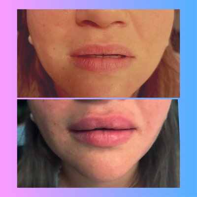 Lip Fillers by Love Your Look by Tara - Are you looking to enhance the appearance of your lips? Look no further! My specialty is lip fillers, and I am here to help you achieve the pout you've always dreamed of. I am highly trained in lip augmentation, using only the highest quality lip fillers to ensure a natural and beautiful result. From subtle to bold, I can tailor my approach to match your desired outcome. Say goodbye to thin, lackluster lips and hello to the luscious, full lips you deserve. I also offer skin rejuvenation treatments tailored to address various skin concerns and help you achieve a youthful and radiant complexion. Give me a call today to schedule your appointment! Lip Fillers by Love Your Look by Tara - Are you looking to enhance the appearance of your lips? Look no further! My specialty is lip fillers, and I am here to help you achieve the pout you've always dreamed of. I am highly trained in lip augmentation, using only the highest quality lip fillers to ensure a natural and beautiful result. From subtle to bold, I can tailor my approach to match your desired outcome. Say goodbye to thin, lackluster lips and hello to the luscious, full lips you deserve. I also offer skin rejuvenation treatments tailored to address various skin concerns and help you achieve a youthful and radiant complexion. Give me a call today to schedule your appointment!