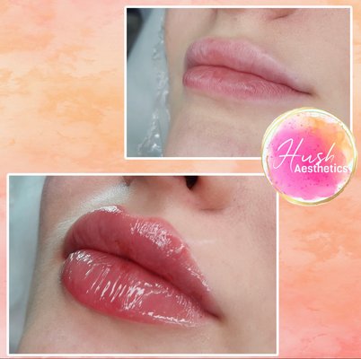 Filler - Dermal fillers Filler - Dermal fillers