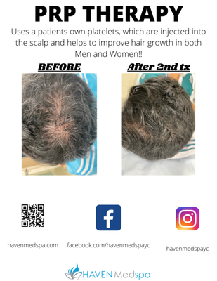 Hair PRP - Platelet Rich Plasma (PRP) therapy is is a treatment used to help restore hair growth. Hair PRP - Platelet Rich Plasma (PRP) therapy is is a treatment used to help restore hair growth.
