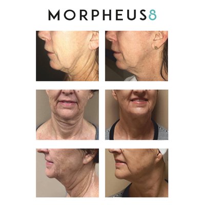 Microneedling with PRP or RF - PRP can enhance collagen and elastin production in deeper skin levels. Microneedling with PRP effectively treats acne scars, surgical scars, wrinkles, and fine lines, hyperpigmentation, sun damage, large pores, uneven skin texture irregularities, and it helps to decrease the appearance of stretch marks. Microneedling with PRP or RF - PRP can enhance collagen and elastin production in deeper skin levels. Microneedling with PRP effectively treats acne scars, surgical scars, wrinkles, and fine lines, hyperpigmentation, sun damage, large pores, uneven skin texture irregularities, and it helps to decrease the appearance of stretch marks.