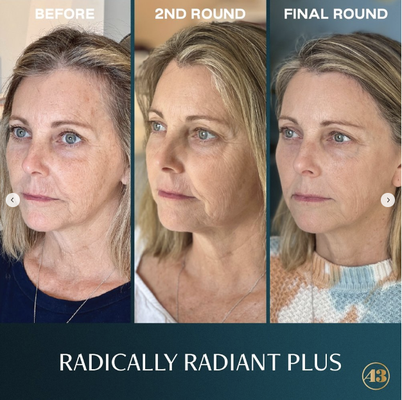 Glow-To Results - Our non-injectable Glow-To treatments include Microneedling, PRP (platelet-rich plasma), Clear + Brilliant Laser, DiamondGlow, and Power Peels.