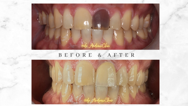 Battle Scar to a Natural Smile - ThisSay goodbye to awkward questions and hello to a radiant transformation. Meet our valiant patient who fought tooth and nail for a stunning smile makeover. It's time to leave the black tooth in the past and embrace the bright future! Battle Scar to a Natural Smile - ThisSay goodbye to awkward questions and hello to a radiant transformation. Meet our valiant patient who fought tooth and nail for a stunning smile makeover. It's time to leave the black tooth in the past and embrace the bright future!