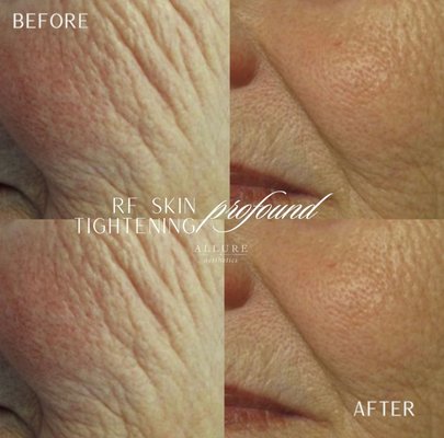 Skin Tightening - At Allure Aesthetics, our Profound RF treatment delivers non-surgical skin tightening and rejuvenation, helping to restore elasticity and lift for a youthful, radiant appearance. This innovative procedure stimulates collagen and elastin production, smoothing fine lines and firming sagging skin for naturally refined results. Each treatment is tailored to your unique needs, providing a luxurious, minimally invasive experience that enhances your overall confidence and elegance. Skin Tightening - At Allure Aesthetics, our Profound RF treatment delivers non-surgical skin tightening and rejuvenation, helping to restore elasticity and lift for a youthful, radiant appearance. This innovative procedure stimulates collagen and elastin production, smoothing fine lines and firming sagging skin for naturally refined results. Each treatment is tailored to your unique needs, providing a luxurious, minimally invasive experience that enhances your overall confidence and elegance.
