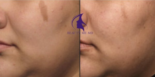 PicoSure Pigmentation Removal - PicoSure Pigmentation Removal: reduce many types of pigmentation, including age spots, sun damage, freckles, melasma & even deep pigmentation. Depending on the type of pigmentation, expect a 50 to 95% improvement with a series of laser sessions.