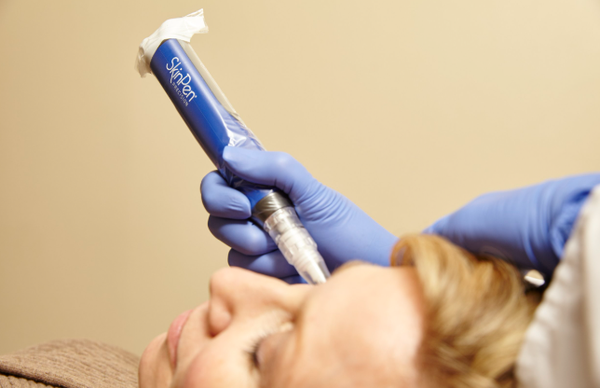 SkinPen Microneedling - SkinPen Microneedling: Tiny sterile needles prick the skin causing small wounds that cause your body to make more collagen and elastin. This will renew skin and address signs of aging. Microneedling can treat acne scars, enlarged pores, improve fine lines, help with skin texture, sun damage and hyperpigmentation. Recommended: minimum of 4 sessions to see maximum results. Final results are seen several weeks after the last treatment. SkinPen Microneedling - SkinPen Microneedling: Tiny sterile needles prick the skin causing small wounds that cause your body to make more collagen and elastin. This will renew skin and address signs of aging. Microneedling can treat acne scars, enlarged pores, improve fine lines, help with skin texture, sun damage and hyperpigmentation. Recommended: minimum of 4 sessions to see maximum results. Final results are seen several weeks after the last treatment.