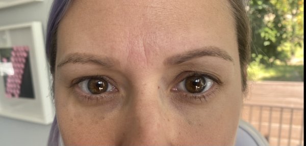 Under Eye Filler - Under eye filler Under Eye Filler - Under eye filler