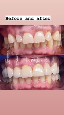 A harmonious smile - A combination of periodontal surgery with laser, crowns, veneers and bridges to achieve this beautiful confident smile A harmonious smile - A combination of periodontal surgery with laser, crowns, veneers and bridges to achieve this beautiful confident smile