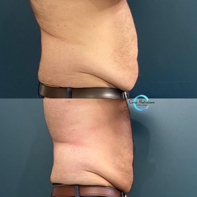 CryoSkin Slimming - CryoSlimming is used to decrease the amount of fat. The treatment lasts 30-40 minutes and is the first of its kind in the US. The 3 phases of the procedure combine heat and cold to naturally destroy fat cells which your body then removes.
Whether your trouble spot is on your stomach, thighs, arms, or back, this is the solution for you! Heat is applied for 2 minutes then cold is applied with temperatures as low as -8ºC.
After the cold, the area is rewarmed to help start moving the dead fat cells out of the area. Your body then moves it through the lymphatic system. You can only have the treatment every 2 weeks to make sure your body has enough time to let the fat cells pass out of your system. CryoSkin Slimming - CryoSlimming is used to decrease the amount of fat. The treatment lasts 30-40 minutes and is the first of its kind in the US. The 3 phases of the procedure combine heat and cold to naturally destroy fat cells which your body then removes.
Whether your trouble spot is on your stomach, thighs, arms, or back, this is the solution for you! Heat is applied for 2 minutes then cold is applied with temperatures as low as -8ºC.
After the cold, the area is rewarmed to help start moving the dead fat cells out of the area. Your body then moves it through the lymphatic system. You can only have the treatment every 2 weeks to make sure your body has enough time to let the fat cells pass out of your system.