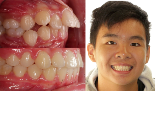 Dr. Wong analyzes every patient's skeletal relationships to ensure optimum aesthetics, health, and stability in their individualized result - Comprehensive analysis of the skeletal relationships that dictate the positions of the jaws and teeth, is one of the many crucial distinctions between orthodontists and general dentists when considering orthodontic treatment, even simple-looking cases.  For example, Cody arrived at our office at age ten with upper incisor protrusion and a small lower jaw, relative to the upper, resulting in an “overbite” (excess overjet).  Like with many other growing children, Dr. Wong utilized an analysis of facial growth patterns, this time employing orthopedic expansion of the maxilla to bring about lateral development of the dental arches.  The results were ideal, leaving Cody’s occlusion in a Class I relationship and his smile beautiful!