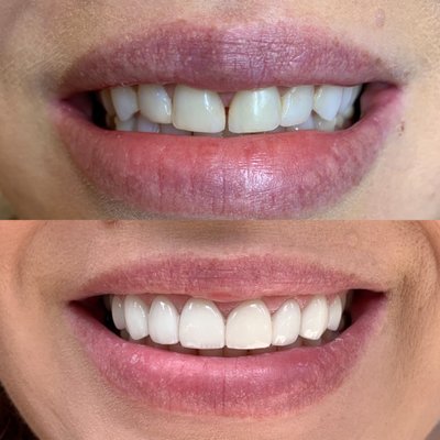 Smile Makeover - These smile makeovers were completed using porcelain veneers, crowns, bridges, and implants.