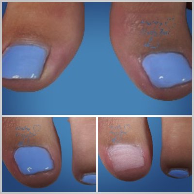 Barefoot Prosthetic Nail - LCN Barefoot is the industry's only gel system designed specifically for toenails. It is an extremely elastic UV/LED gel, which adapts to the movements of the toes. Its unique adhesive properties mean that good results can even be achieved on calloused layers of skin where there is no toe nail.