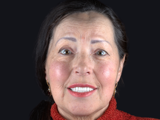 Full-Arch Implant Before & Afters - Wondering how full-arch dental implants could improve your smile? Explore detailed before-and-after results showing changes in tooth shape, alignment, and overall appearance. Every patient is different, schedule a consultation to learn which treatment options may be right for you. Full-Arch Implant Before & Afters - Wondering how full-arch dental implants could improve your smile? Explore detailed before-and-after results showing changes in tooth shape, alignment, and overall appearance. Every patient is different, schedule a consultation to learn which treatment options may be right for you.