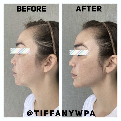 Jawline Contouring - Jawline contouring is an advanced technique to chisel the jawline and chin with dermal filler. Jawline Contouring - Jawline contouring is an advanced technique to chisel the jawline and chin with dermal filler.