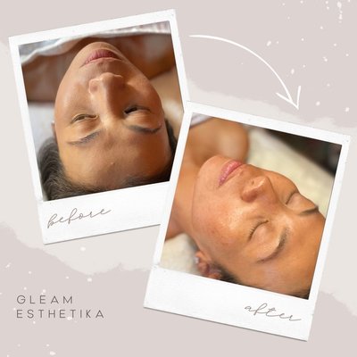 Irresistible Glow Facial - The Irresistible Glow Facial with Red Light Therapy is designed to help with a range of skin concerns. It is particularly beneficial for:

	•	Reducing Inflammation: Red light therapy is known for its anti-inflammatory effects, helping to calm irritated or red skin.
	•	Boosting Collagen Production: This therapy stimulates collagen and elastin production, which can reduce the appearance of fine lines and wrinkles, giving skin a firmer and more youthful look.
	•	Improving Skin Tone and Texture: It targets uneven skin tone, hyperpigmentation, and rough texture, leaving skin visibly smoother.
	•	Acne Reduction: Red light helps to reduce acne by killing bacteria and reducing oil production, making it a great option for acne-prone skin.

This treatment, paired with high-quality products, gives the skin an intense radiance and promotes long-term skin health.
