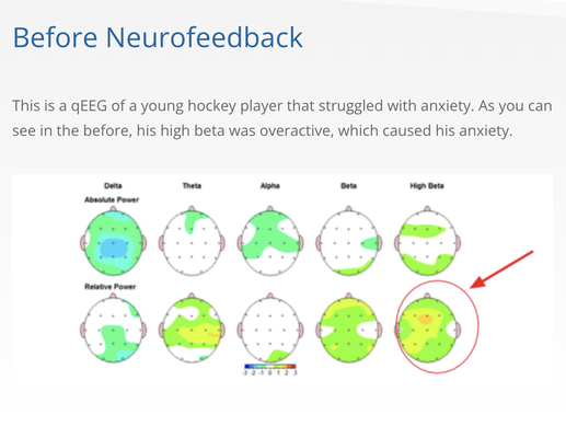 Neurofeedback/Conditioning strengthens, calms, and stabilizes the brain. - The overall goal of Neurofeedback is to improve neurological flexibility. The brain is optimally supposed to shift easily between states, from sleep, to relaxation, to calm, to alert, to high alert when needed. Once your brain is “trained,” it can then shift on its own (as opposed to being “stuck” in a state of anxiety, anger, etc.)
Dr. Daniel Amen, a well-known psychiatrist often seen on PBS, has written many books on the brain. He specializes in brain scans and recommends Neuro-feedback as the most ideal treatment option. Amen says that “a healthy brain tends to be: focused, happy, relaxed, loving, and effective while an unhealthy brain tends to be distracted, sad, anxious, angry, and not as effective.
According to Dr. Siegfried Othmer, a key researcher and clinician in Neurofeedback, claims that Neurofeedback not only helps restore healthier functioning, but prevents future neurological dysfunction due to severe trauma such as a concussion/TBI or cognitive decline due to aging. Neurofeedback/Conditioning strengthens, calms, and stabilizes the brain. - The overall goal of Neurofeedback is to improve neurological flexibility. The brain is optimally supposed to shift easily between states, from sleep, to relaxation, to calm, to alert, to high alert when needed. Once your brain is “trained,” it can then shift on its own (as opposed to being “stuck” in a state of anxiety, anger, etc.)
Dr. Daniel Amen, a well-known psychiatrist often seen on PBS, has written many books on the brain. He specializes in brain scans and recommends Neuro-feedback as the most ideal treatment option. Amen says that “a healthy brain tends to be: focused, happy, relaxed, loving, and effective while an unhealthy brain tends to be distracted, sad, anxious, angry, and not as effective.
According to Dr. Siegfried Othmer, a key researcher and clinician in Neurofeedback, claims that Neurofeedback not only helps restore healthier functioning, but prevents future neurological dysfunction due to severe trauma such as a concussion/TBI or cognitive decline due to aging.