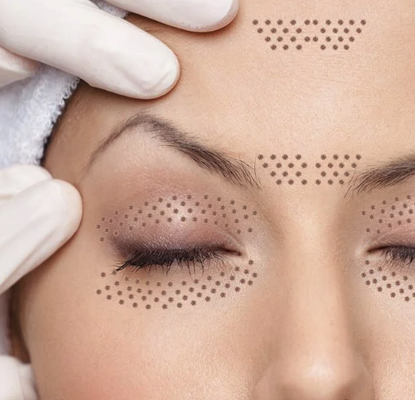 Plasma Pen - Our med spa is proud to offer Plasma Pen services, an innovative and non-invasive treatment that effectively tightens and rejuvenates the skin, targeting fine lines, wrinkles, and sagging areas with precision. Utilizing the latest plasma technology, this treatment stimulates fibroblast activity in the skin, encouraging the production of collagen and elastin for a firmer, more youthful appearance. Our skilled practitioners customize each treatment to the client's specific needs, ensuring a safe and satisfying experience with noticeable results.