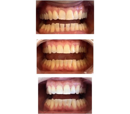 Invisalign - Before and after photos showing effect of Invisalign. Invisalign® clear aligners are the alternative teeth straightening treatment to braces of teeth for kids, teens, and adults. Invisalign - Before and after photos showing effect of Invisalign. Invisalign® clear aligners are the alternative teeth straightening treatment to braces of teeth for kids, teens, and adults.