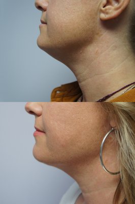 Liposuction - Patients with excess fat only and good skin tone may be treated with liposuction alone. Scars are very hard to detect. Removes excess fat throughout the body with very small scars Often causes minor skin tightening.