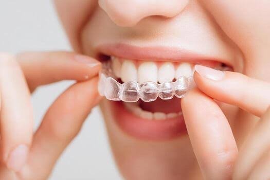 Clear Aligner treatment - Are you happy with your SMILE?  Let us help you achieve the smile of your dreams.  We are here to help people of any age create a confident smile.  We offer free consultations and if you mention YELP you will receive $250 off aligner treatment.