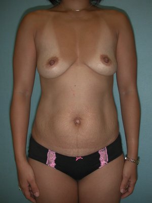Mommy Makeover - Mommy Makeover typically combines a Tummy Tuck with Breast Rejuvenation surgery (Augmentation, Augmentation with a Lift, Lift Alone or Reduction) and Liposuction to reverse the effects of pregnancy. Mommy Makeover - Mommy Makeover typically combines a Tummy Tuck with Breast Rejuvenation surgery (Augmentation, Augmentation with a Lift, Lift Alone or Reduction) and Liposuction to reverse the effects of pregnancy.
