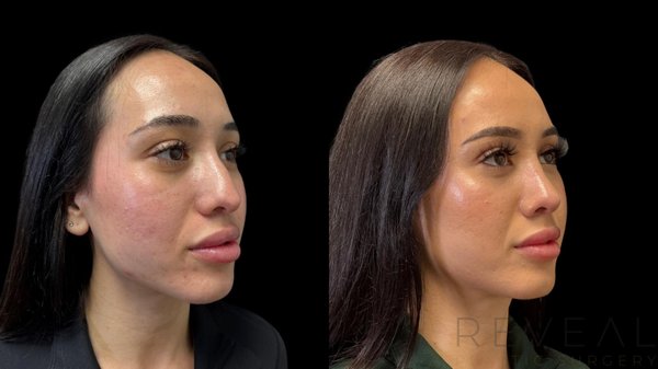 Rhinoplasty - Our rhinoplasty gallery features real patient transformations, showcasing the subtle yet powerful impact of nose reshaping. Whether the goal was to refine a nasal hump, correct asymmetry, or improve the nasal tip, each result reflects a personalized approach tailored to the individual’s facial features and goals.
Performed by our skilled, board-certified surgeon, these before-and-after images demonstrate a commitment to natural-looking outcomes that complement the patient’s unique facial harmony. Every case highlights the precision, artistry, and advanced techniques involved in achieving balanced, refined results.
Explore the gallery to see how rhinoplasty can improve both appearance and confidence—while preserving what makes each face unique. Rhinoplasty - Our rhinoplasty gallery features real patient transformations, showcasing the subtle yet powerful impact of nose reshaping. Whether the goal was to refine a nasal hump, correct asymmetry, or improve the nasal tip, each result reflects a personalized approach tailored to the individual’s facial features and goals.
Performed by our skilled, board-certified surgeon, these before-and-after images demonstrate a commitment to natural-looking outcomes that complement the patient’s unique facial harmony. Every case highlights the precision, artistry, and advanced techniques involved in achieving balanced, refined results.
Explore the gallery to see how rhinoplasty can improve both appearance and confidence—while preserving what makes each face unique.