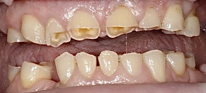 Smile Restoration - This patient's teeth were severely worn down. He wanted a better looking smile so he came to see us at Elite Dental. Smile Restoration - This patient's teeth were severely worn down. He wanted a better looking smile so he came to see us at Elite Dental.
