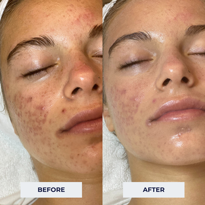 Teen Clean & Clear Facial Treatment - This client received the Teen Clean & Clear Facial Treatment, which includes all of the following:
-Dual cleanse infused with the soothing embrace of steam
-Refined exfoliation, unveiling your skin’s hidden luminosity
-Ultra gentle, yet meticulous extractions
-Customized masque treatment, chosen specifically for your skin
-Improve texture and tone with the magic of high frequency
-Conclude with a relaxing scalp and shoulder massage plus finishing touches Teen Clean & Clear Facial Treatment - This client received the Teen Clean & Clear Facial Treatment, which includes all of the following:
-Dual cleanse infused with the soothing embrace of steam
-Refined exfoliation, unveiling your skin’s hidden luminosity
-Ultra gentle, yet meticulous extractions
-Customized masque treatment, chosen specifically for your skin
-Improve texture and tone with the magic of high frequency
-Conclude with a relaxing scalp and shoulder massage plus finishing touches