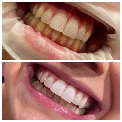 Professional Teeth Whitening - Each professional whitening session is 40 minutes and can even be done right before tanning if desired!
During your appointment, prescription strength gel is applied to the enamel, avoiding the gums and lips. Results are instant, lightening teeth 2-4 shades whiter each session and continue to develop over 24 hours post session. Results last based on personal staining habits like red wine and coffee consumption. Typically our clients whiten their teeth 1-3x a year with us.
You should brush your teeth before your session and eat, as you will want to only consume water after for up to two hours after your appointment. Dark staining foods such as red pasta sauces, wine and coffee should be avoided for 24h after your treatment as teeth are continuing to brighten.
Our gel is different from other whitening options in several ways: it’s safe on enamel, protects gums, causes little to no-sensitivity, is a registered natural health product and on top of all that, it’s more cost-effective. Professional Teeth Whitening - Each professional whitening session is 40 minutes and can even be done right before tanning if desired!
During your appointment, prescription strength gel is applied to the enamel, avoiding the gums and lips. Results are instant, lightening teeth 2-4 shades whiter each session and continue to develop over 24 hours post session. Results last based on personal staining habits like red wine and coffee consumption. Typically our clients whiten their teeth 1-3x a year with us.
You should brush your teeth before your session and eat, as you will want to only consume water after for up to two hours after your appointment. Dark staining foods such as red pasta sauces, wine and coffee should be avoided for 24h after your treatment as teeth are continuing to brighten.
Our gel is different from other whitening options in several ways: it’s safe on enamel, protects gums, causes little to no-sensitivity, is a registered natural health product and on top of all that, it’s more cost-effective.