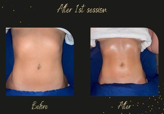 Before | After - As the owner and operator of Lymphatic Glow I am dedicated to the precise execution and 100% client satisfaction of all returning & newcomers.

Whether you're needing post-op lymphatic care, lymphatic system detoxes, or things body contouring related we've got you covered.

Expect the highest quality service from this highly trained professional, devoted to facilitating healing and whole-body well-being. Whether you want to melt your stress away with a relaxing massage or need a treatment customized for your specific needs, Lymphatic Glow is the business to call! Available immediately   for guidance & open by appointment only so call or text today with questions or BOOK ONLINE!