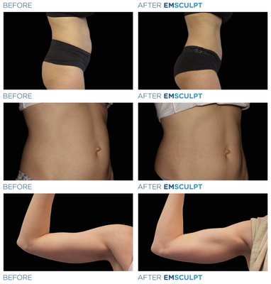 EMSculpt Neo - EMSCULPT Neo is the first device available to build new muscle fibers and eliminate fat cells, all at the same time in one single treatment.
A single EMSCULPT Neo session causes thousands of powerful muscle contractions which force the tissue to adapt to such extreme condition. It responds with a deep remodeling of its inner structure that results in muscle building and sculpting your body.
FDA Cleared For 5 Body Parts: abdominals, buttocks, arms, calves, and thighs.
30% reduction in subcutaneous fat
25% increase in muscle EMSculpt Neo - EMSCULPT Neo is the first device available to build new muscle fibers and eliminate fat cells, all at the same time in one single treatment.
A single EMSCULPT Neo session causes thousands of powerful muscle contractions which force the tissue to adapt to such extreme condition. It responds with a deep remodeling of its inner structure that results in muscle building and sculpting your body.
FDA Cleared For 5 Body Parts: abdominals, buttocks, arms, calves, and thighs.
30% reduction in subcutaneous fat
25% increase in muscle