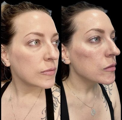 Dermal filler, Botox, and PRF Injections - Dermal filler, Botox, and PRF Injection transformation at ZO Skin Centre Dallas Dermal filler, Botox, and PRF Injections - Dermal filler, Botox, and PRF Injection transformation at ZO Skin Centre Dallas